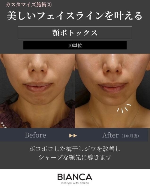 ボトックス注射_顎ボトックス